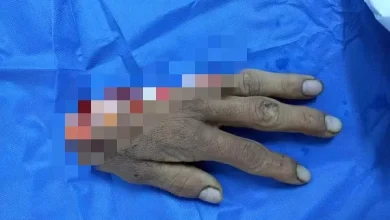 ملحمة طبية على أرض الفيوم .. فريق طبي ينجح في إعادة يد مبتورة لجسم صاحبها بمستشفى عام