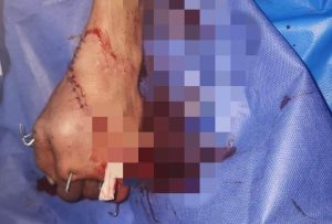 ملحمة طبية على أرض الفيوم .. فريق طبي ينجح في إعادة يد مبتورة لجسم صاحبها بمستشفى عام