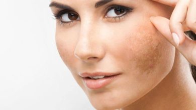 علاج الكلف القديم في المنزل .. وصفات طبيعية