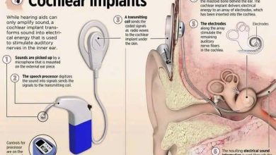 زراعة قوقعة الأذن أو الحلزون cochlear implants